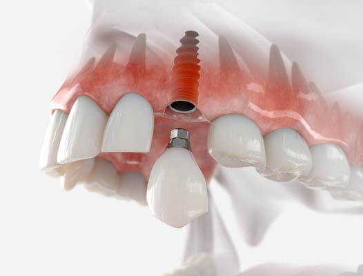 Dental Implant Tulare, CA
