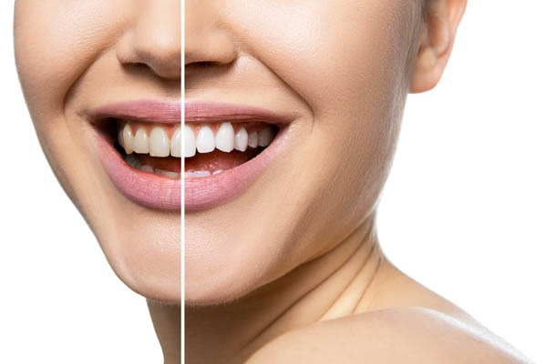 Maintenance Tips After Professional Teeth Whitening